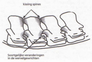 kissing spine anatomie